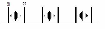 Phonogram of AS showing a systolic crescendo-decrescendo sound